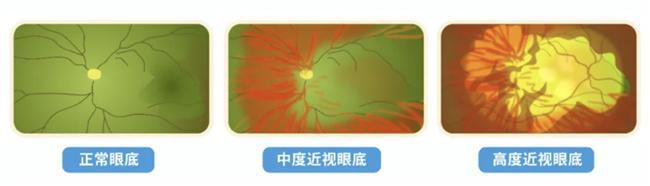 孩子近视防控该怎么做？爱尔眼科这3招一定要学会(图1)