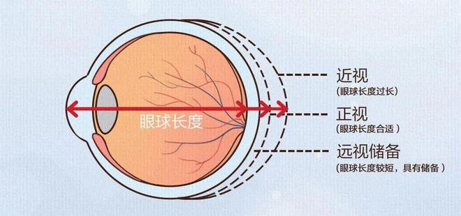 九游娱乐NineGame：近视真的不能恢复吗？这篇文章说明白了(图4)