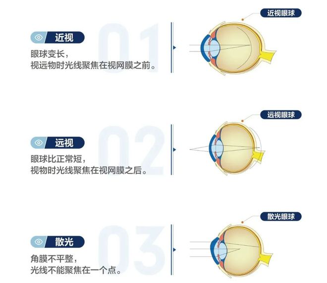 九游娱乐NineGame：近视真的不能恢复吗？这篇文章说明白了(图2)