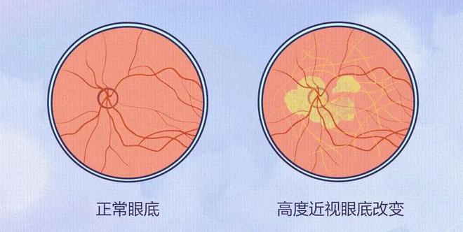 九游娱乐NineGame：近视真的不能恢复吗？这篇文章说明白了(图5)