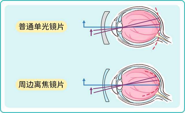警惕假冒防控镜片伤害孩子视力健康科学选购是关键(图3)