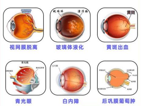 九游娱乐NineGame：近视600度不仅是戴眼镜那么简单！贵港华厦爱眼给高度近视建议(图1)